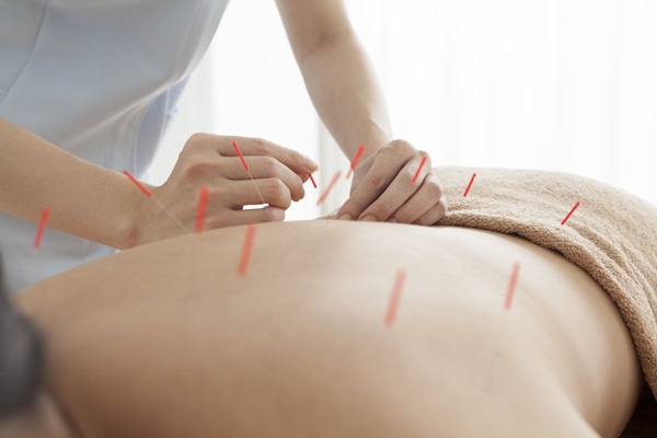 Acupuncture for Sports Injuries