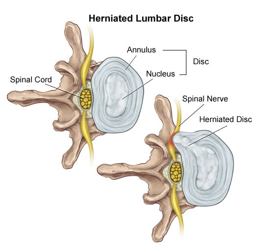 Herniated Disc Symptoms Diagram