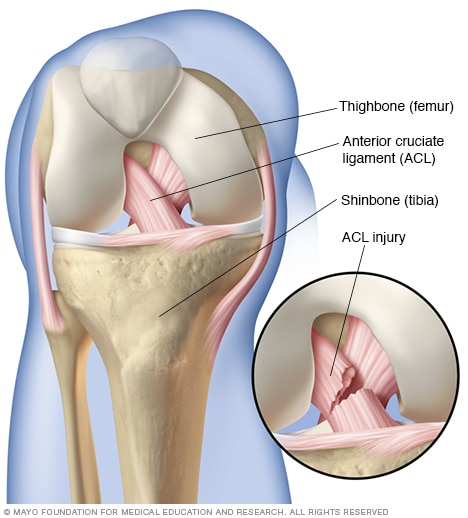 ACL Injury Medical Illustration