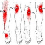 Gastrocnemius