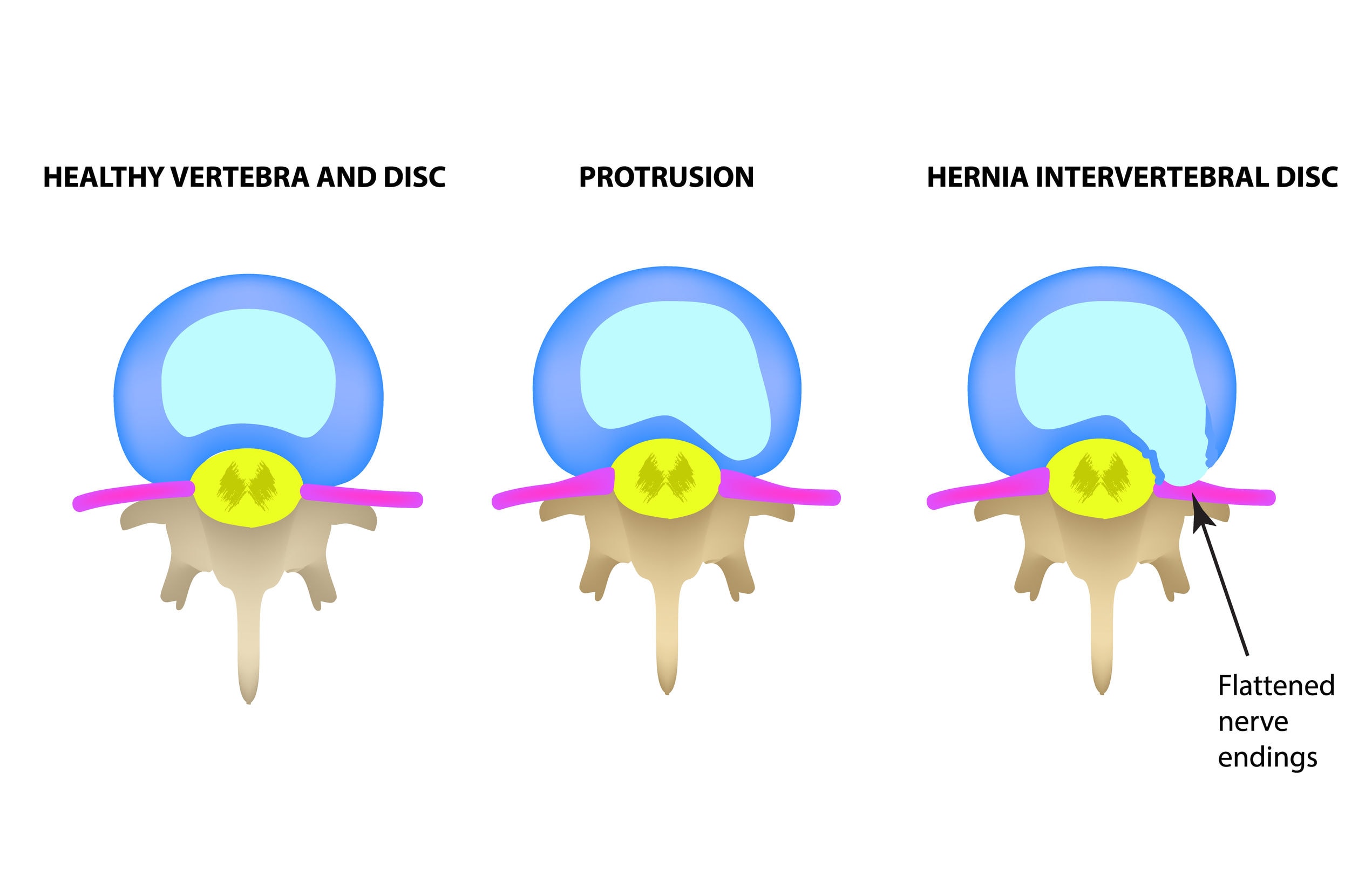 Mechanical Traction and Decompression - Mechanical Traction and Decompression Therapy for the Spine | https://physiologicnyc.com/chiropractic/