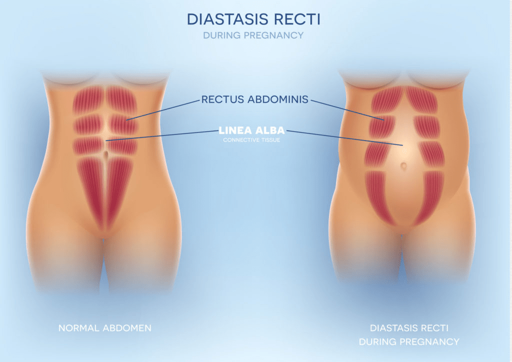 Diastasis Recti in Postpartum Health | https://physiologicnyc.com/physical-therapy/